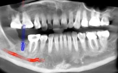 dental implant on a x-ray