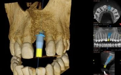 Implant in the jawbone