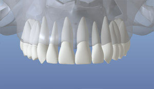 normal jaw of teeth