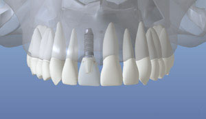 dental implant in the jaw