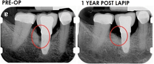 pre-op vs 1 year post op for LAPIP