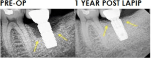 pre-op vs 1 year post op for LAPIP