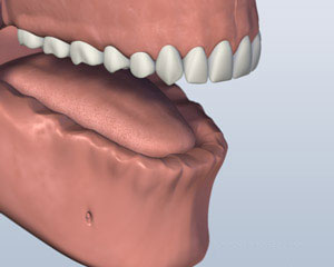 lower jaw of teeth missing