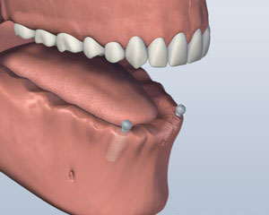 dental implants in place for an implant-supported denture