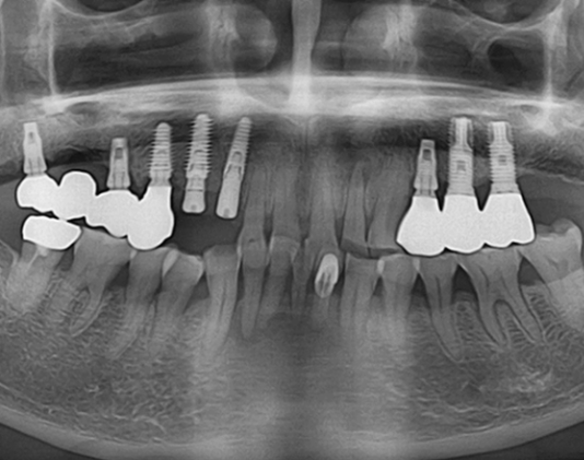 dental x-ray showing dental implants in the jaw