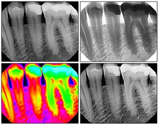 dental x-rays